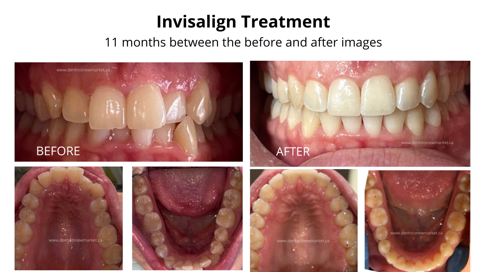 https://www.dentistsnewmarket.ca/hub_sites/smiles-summerhill/www/assets/uploads/images/invisalign-smiles-at-summerhill-dental-newmarket-aurora-ontario.png