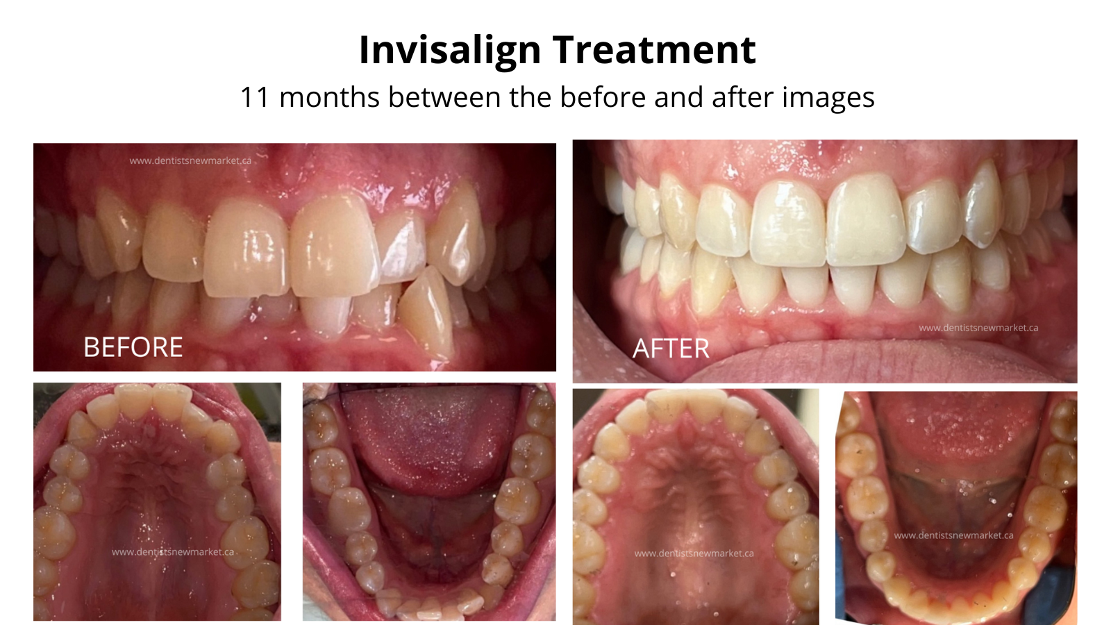 Invisalign® Treatment - Smiles at Summerhill Dental